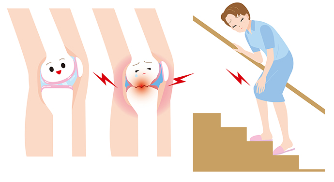 ひざの痛みを引き起こす様々な要因